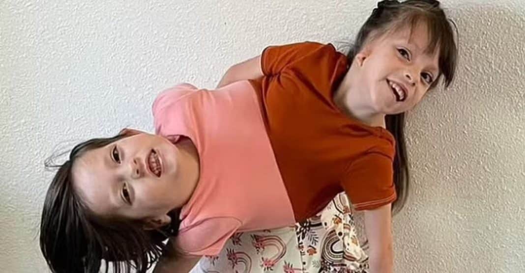 Mãe e pai de gêmeas siamesas que tinham 5% de chance de sobreviver revelam como elas estão agora