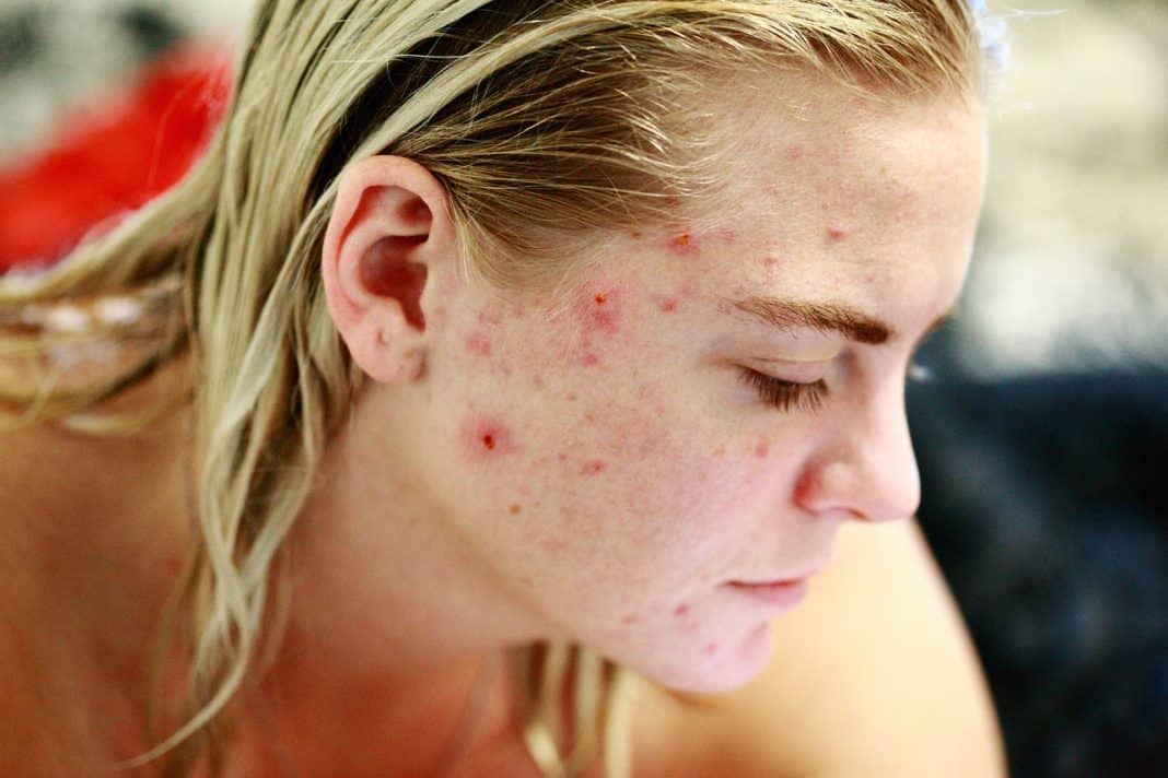 Manchas de acne: alternativas para diminuir as hiperpigmentação na pele