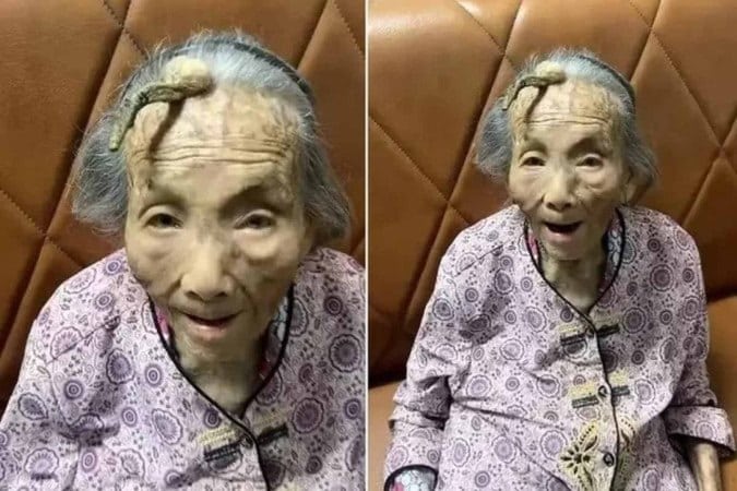 pensarcontemporaneo.com - Caso raríssimo: Chinesa de 107 anos viraliza ao mostrar chifre de 10 cm crescendo na testa - veja imagens