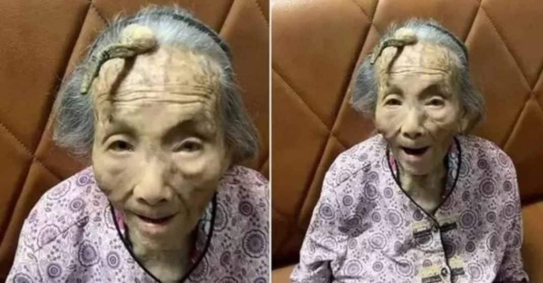 Caso raríssimo: Chinesa de 107 anos viraliza ao mostrar chifre de 10 cm crescendo na testa – veja imagens