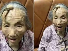 Caso raríssimo: Chinesa de 107 anos viraliza ao mostrar chifre de 10 cm crescendo na testa - veja imagens