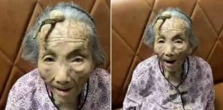 Caso raríssimo: Chinesa de 107 anos viraliza ao mostrar chifre de 10 cm crescendo na testa - veja imagens